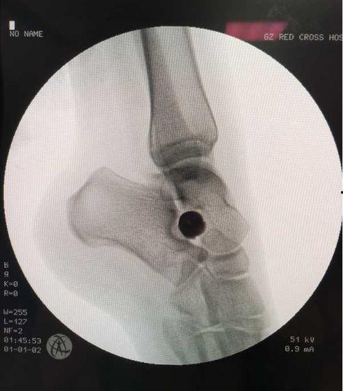 成人骨科矫正足弓视频