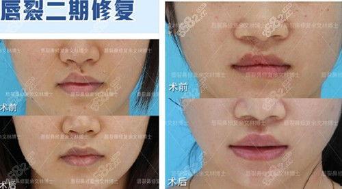 成人唇裂内切案例视频,成人唇裂内切手术全过程揭秘