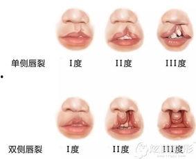 成人唇裂内切案例视频,成人唇裂内切手术全过程揭秘