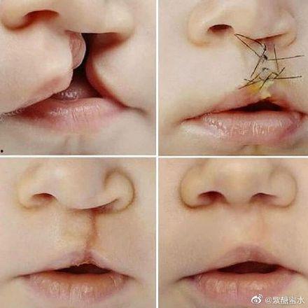 成人唇裂内切案例视频,成人唇裂内切手术全过程揭秘