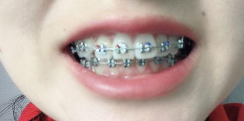 成人黑牙齿视频大全播放,视频大全带你了解口腔健康秘密