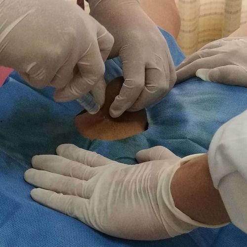 成人包皮手术医生视角视频,医生视角下的手术过程与注意事项