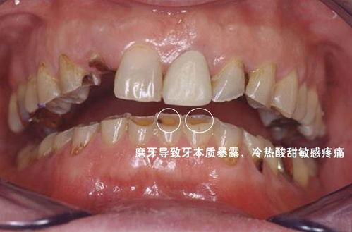 成人磨牙要打虫吗视频,成人磨牙需打虫？揭秘磨牙背后的真相